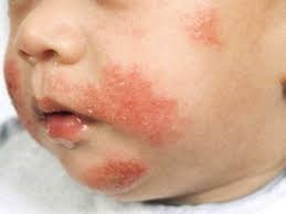 Bệnh da thường gặp ở trẻ